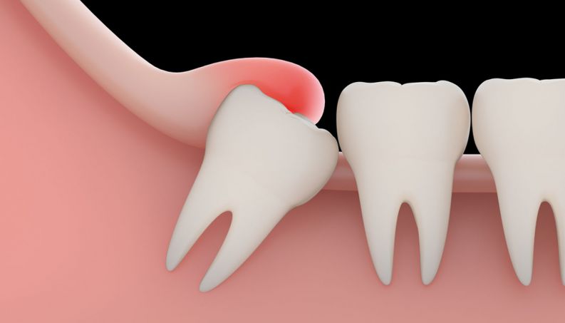 dente-do-siso