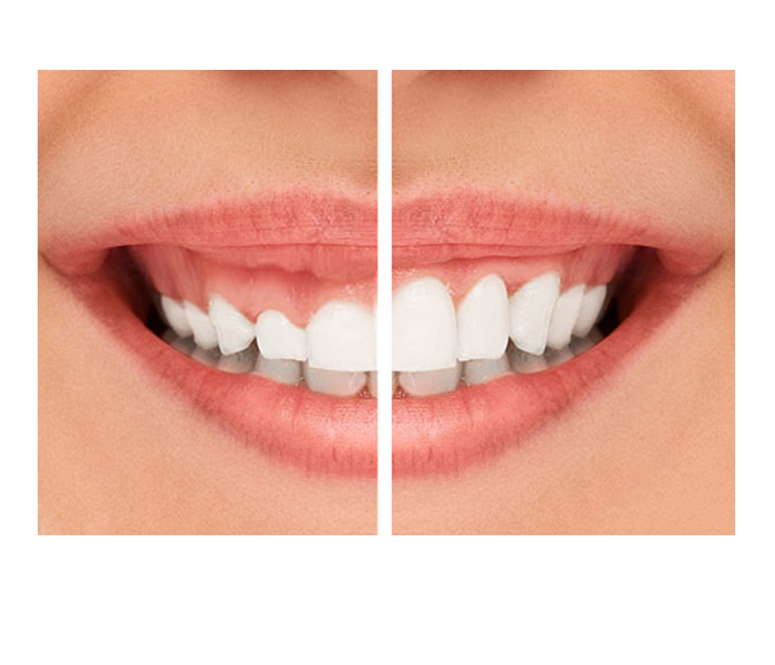 gengivoplastia