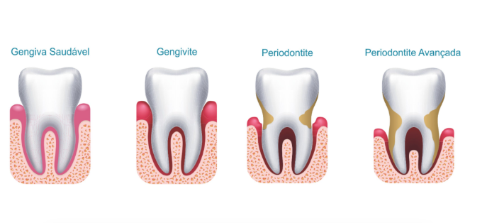 periodontia-mcrodonto
